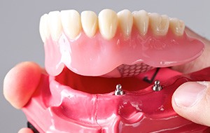 Model all-on-4 dental Implant supported denture