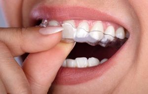 person inserting nightguard for bruxism