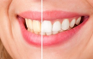 Smile half beforeand half after teeth whitening