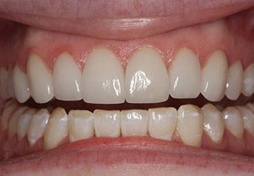 Beautiful smile after teeth whitening