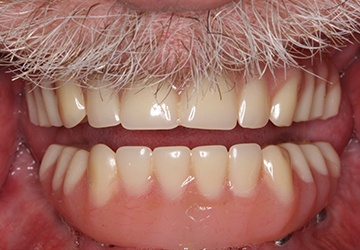Teeth with large metal fillings
