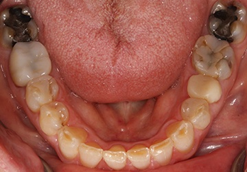 Damaged teeth and gums before cosmetic dentistry