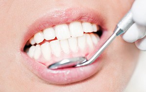 Closeup of healthy teeth and gums after laser gum contouring