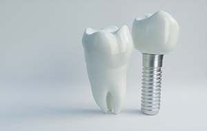 model of a real tooth next to a dental implant in Lincoln