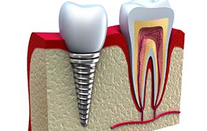 model of a real tooth in the jaw next to a dental implant