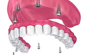 model of a full implant denture
