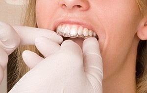 Closeup of dentist placing Invialign tray