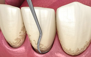 Illustration of scaling treatment