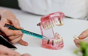 Dentist pointing to sample implant bridge with green pen