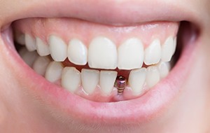 Closeup of a dental implant