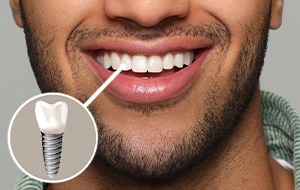 Nose-to-chin closeup of man smiling with front tooth indicated as implant