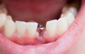 Dental implant visible in smile line closeup
