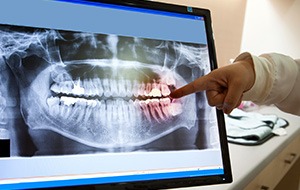 Digital dental x-rays on computer