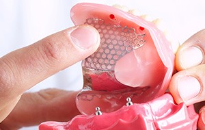 Model of an all-on-4 denture