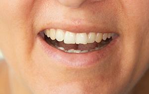Closeup of a chipped tooth