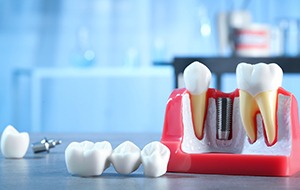 An implant dental bridge