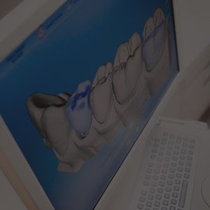 Digital impressions of teeth on computer screen