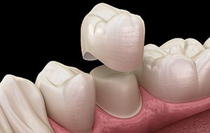 A dental crown is a dental restoration that fits over your tooth like a cap