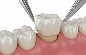 Dental crowns require two appointments at Olberding Dental