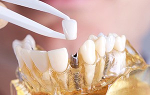 Model of implant supported dental crown