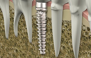 Animation of implant post