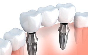 Animation of implant supported dental crown
