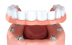 Animation of implant denture