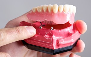 Model of all-on-4 denture