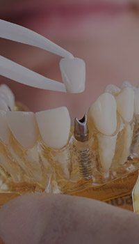 Dentist placing dental crown on model of dental implant