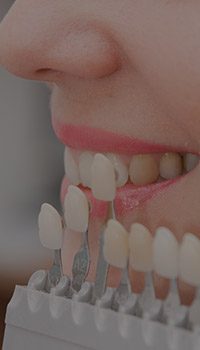 Close up of smile next to dental veneer color chart