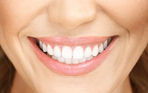Closeup of healthy flawless smile after full mouth rehabilitation