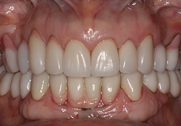 Flawless white top teeth after teeth whitening