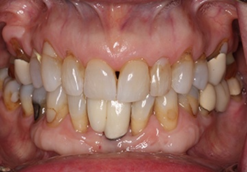 Yellow colored top teeth before teeth whitening