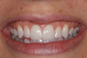 Brilliant white beautiful smile after cosmetic dentistry