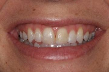 Severely discolored and decayed smile before cosmetic dentistry
