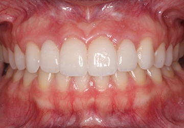 Flawlessly repaired smile after cosmetic dentistry