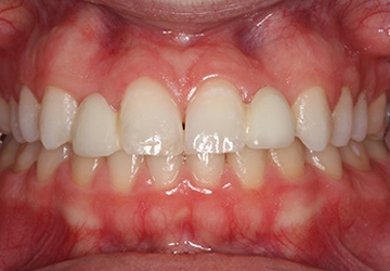 Decayed and worn smile before cosmetic dentistry