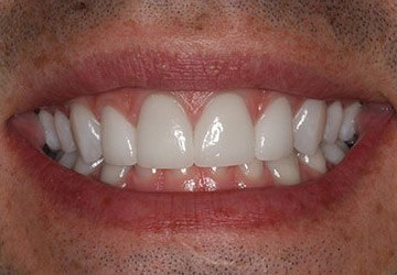 Brightened top two teeth after teeth whitening