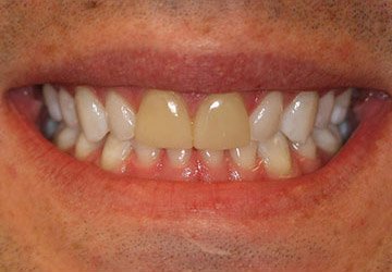 Yellowed top two teeth before teeth whitening