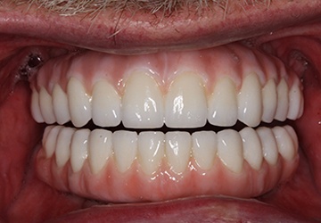 Teeth with tooth-colored fillings