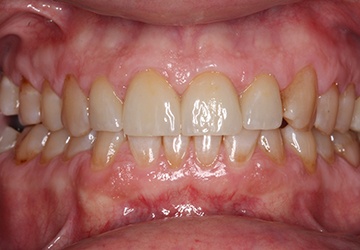 Teeth with tooth-colored fillings