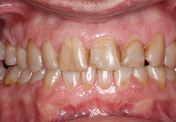 Teeth with large metal fillings