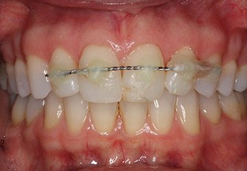 Smile with orthodontic appliance in place