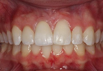 Perfected smile after dental resotration is attached to dental implant post