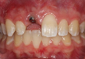 Gap in smile with visible dental implant post