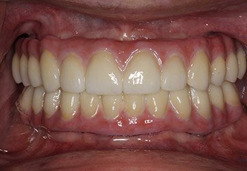 Healthy teeth and gums after cosmetic dentistry