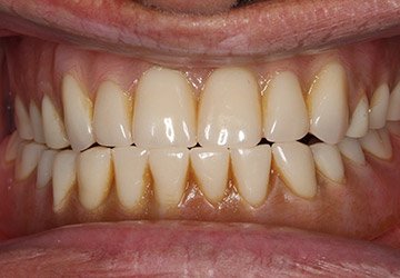 Damaged teeth and gums before cosmetic dentistry