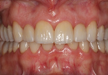 Healthy teeth and gums after cosmetic dentistry