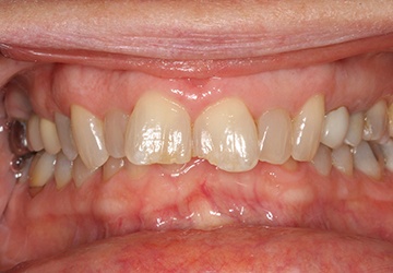 Damaged teeth and gums before cosmetic dentistry