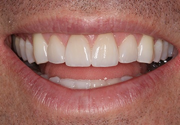 Healthy teeth and gums after cosmetic dentistry